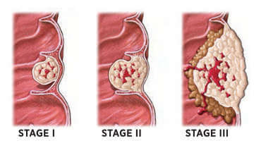 Colorectal Cancer Stages