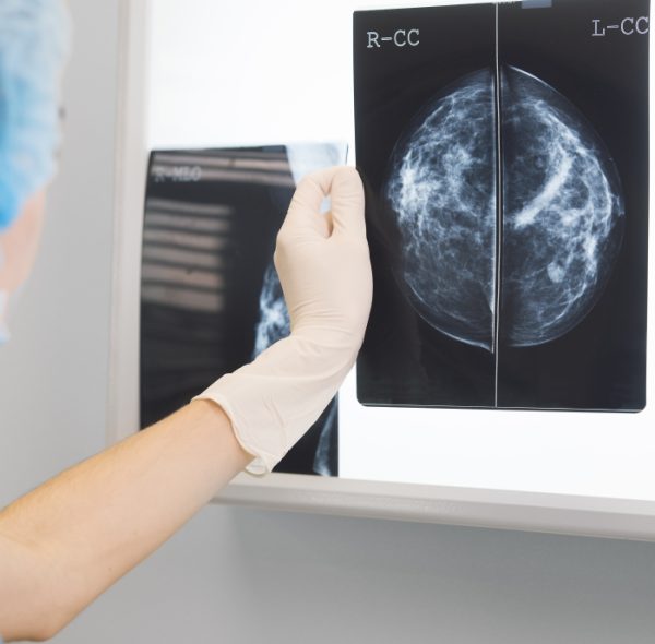 Mamografía y MRI de senos: ¿cuál es la diferencia?
